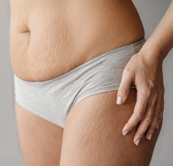 Stretch Marks Treatment